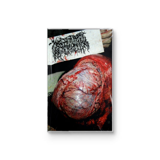 Malignant Hyperthermia "Cutaneous Blastomycosis" CASSETTE